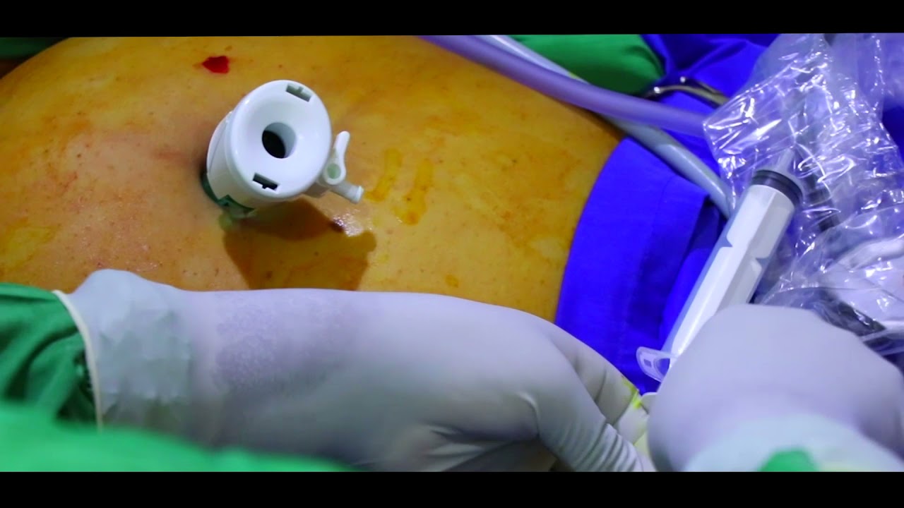 Tanganyika Hospital - Ushuhuda wa mgonjwa aliyekuwa na kibofu nyongo