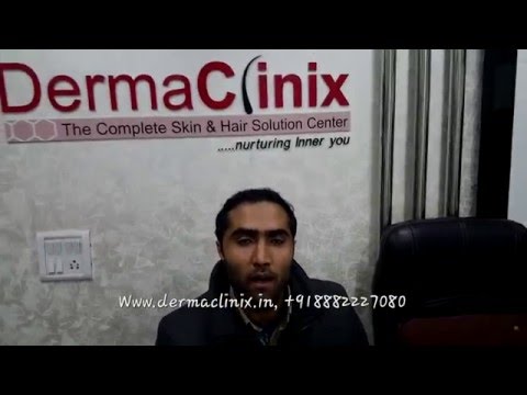 Bio Stimulated FUE Hair Transplant Result in Delhi - Dr. Amrendra Kumar