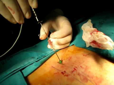 Sintomi positivi della malattia degenerativa del disco della colonna cervicale Vertigini e sonnolenza in osteocondrosi