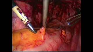 TPEA Lifter - Deep Endometriosis