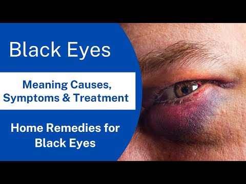 Black Eye: Causes, Symptoms, Prevention, and Treatment | Home Remedies for Black Eyes