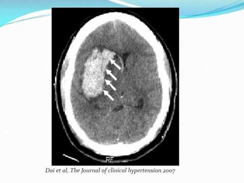 Pépins de raisin et lhypertension Traitement de lhypertension hépatique