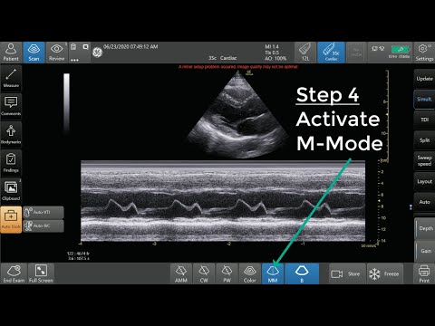 Ultrasound M-Mode Step by Step Guide. E Point Septal Separation (EPSS) Example