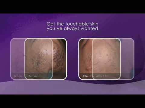Cynosure Elite+ Laser  Hair removal