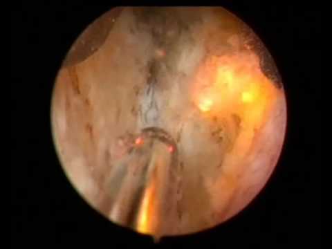 Wie zu verstehen, gibt es Prostatitis oder nicht Traditionelle Medizin aus Prostatitis und Impotenz