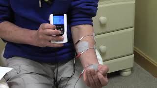 Stroke Rehabilitation: Use of electrical stimulation to help the fingers be able to open and close