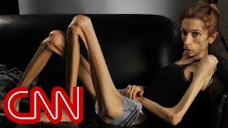 Anorexic woman&#39;s dramatic transformation