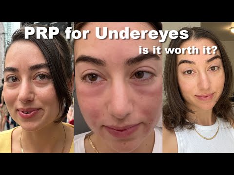 Trying Under Eye PRP Injections for the First Time