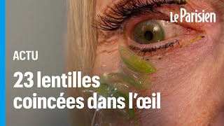 23 lentilles retirées de l’œil d’une patiente : «Ne dormez pas avec», alerte une ophtalmologue