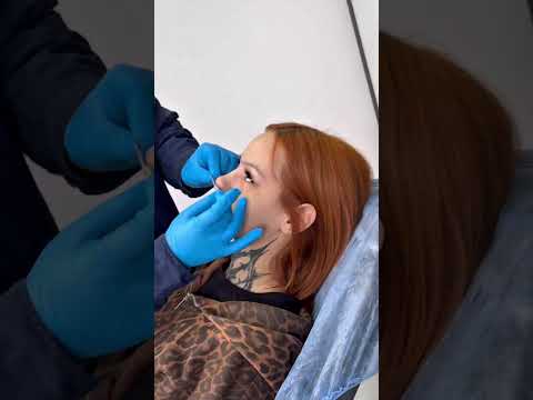 Cast replacement after rhinoplasty