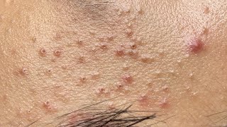 Soothing Facial Treatment for Acne-Prone Skin 645 P3