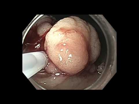 Colonoscopy: Rectum - Large Polyp Resection - 2 hours