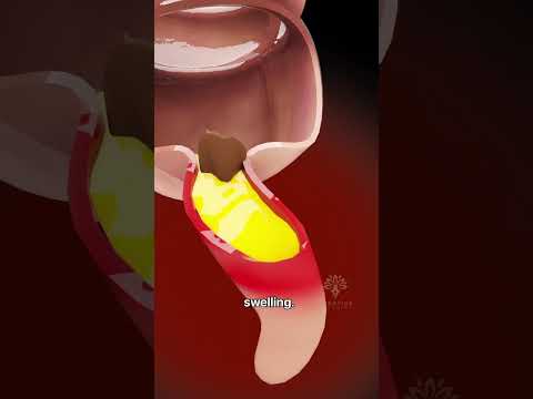 How Appendicitis Happens | appendix symptoms #shorts - creativelearning3d