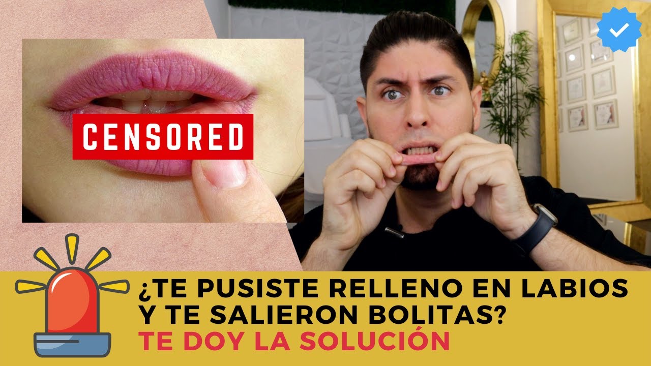 Watch Bolitas en los labios por RELLENO con ÁCIDO HIALURÓNICO / DOCTOR LEMUS Now Bolitas en los labios por RELLENO con ÁCIDO HIALURÓNICO / DOCTOR LEMUS