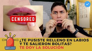 Bolitas en los labios por RELLENO con ÁCIDO HIALURÓNICO / DOCTOR LEMUS