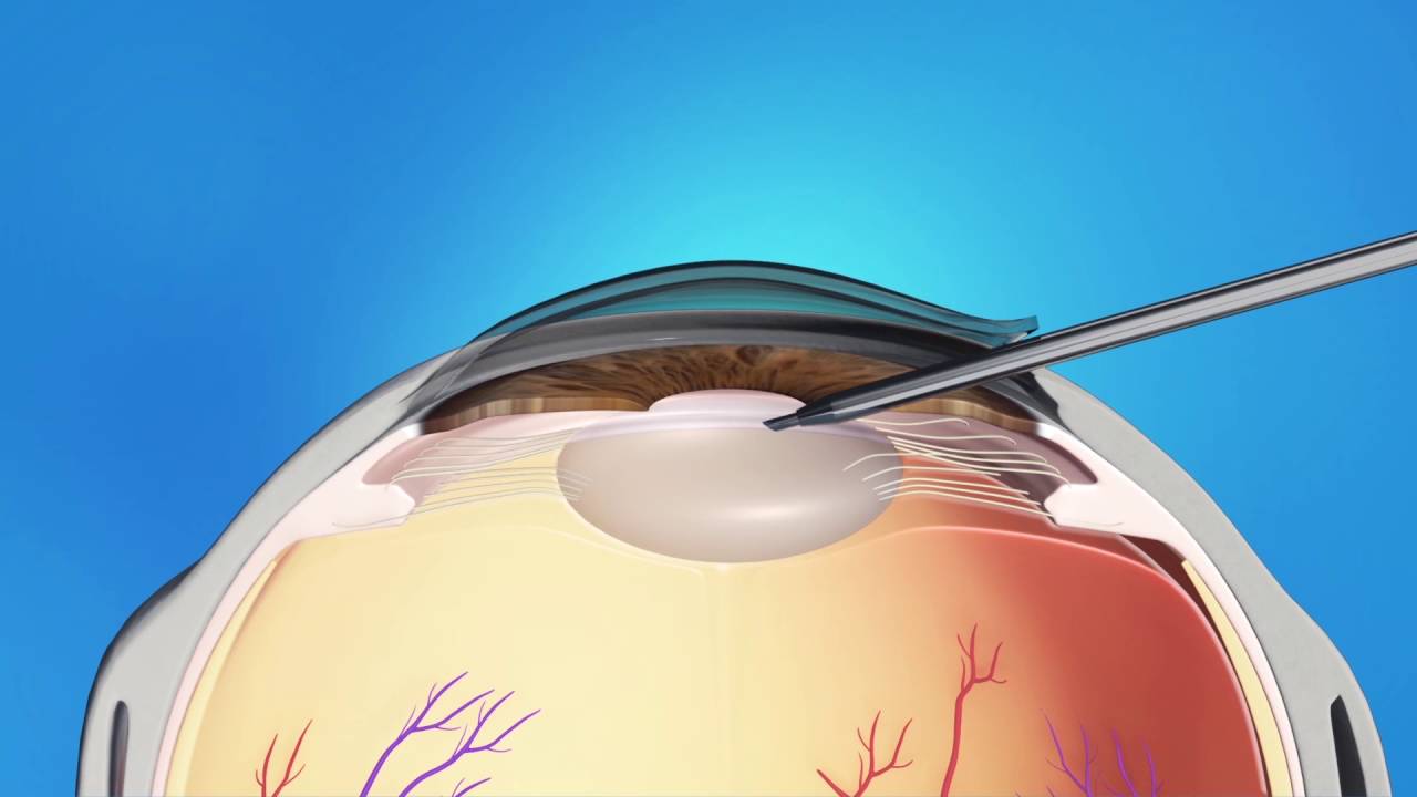 Phaco Refractive Lens Exchange