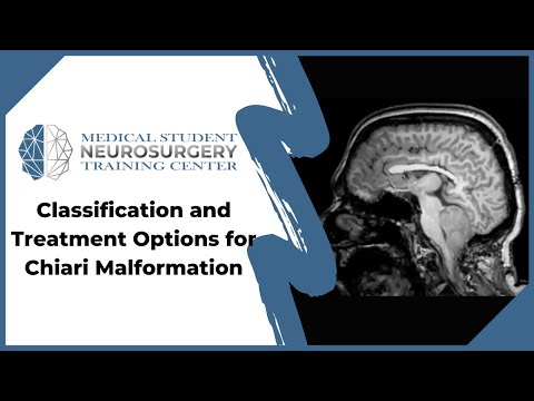 Classification and Treatment Options for Chiari Malformation