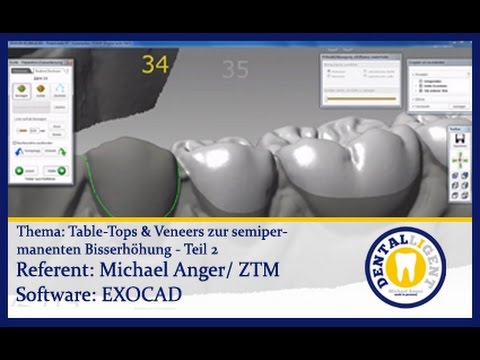EXOCAD TUTORIAL - Teaser - Table-Tops & Veneers zur semipermanenten Bisserhöhung Teil 2