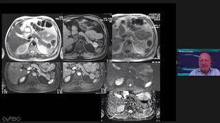 Pancreatic cystic lesions by Dr Gianni Morana