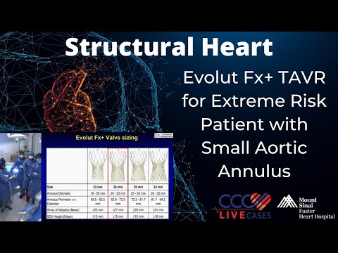 Evolut Fx+ TAVR for Extreme Risk Patient with Small Aortic Annulus