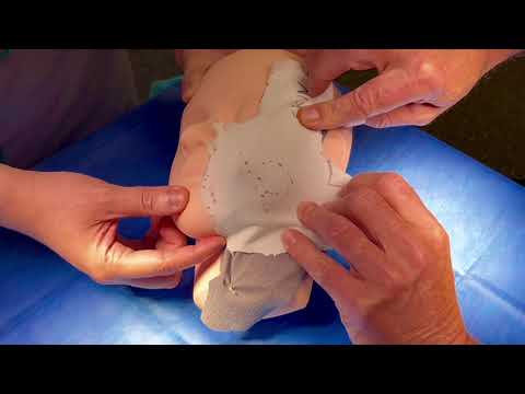 Deep Plane Facelift vs Weekend (SMAS) Facelift Demonstration (Non-Graphic)