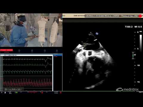Transcatheter Mitral Valve Repair (MitraClip) For Severe MR