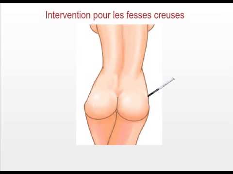 comment augmenter hcg