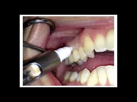 Intraosseous LA injection technique