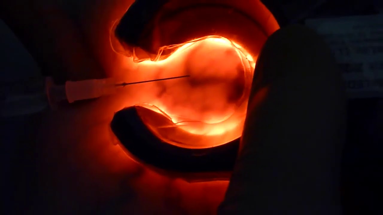 Sclerotherapy with Veinlite LEDX®