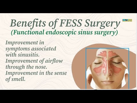 Benefits of FESS Surgery
