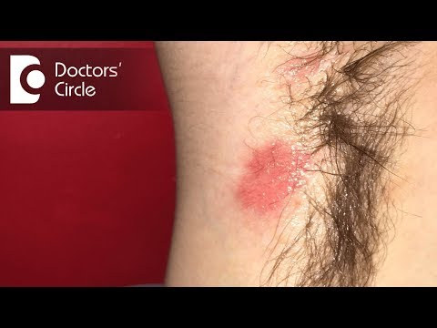 How to deal with red patches over underarms? - Dr. Swetha Sunny Paul