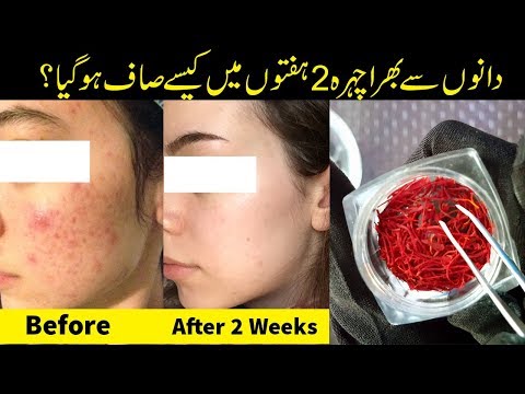 Pimple Acne Crop - Get Rid Fast Permanent Solution Home Remedy Urdu Hindi