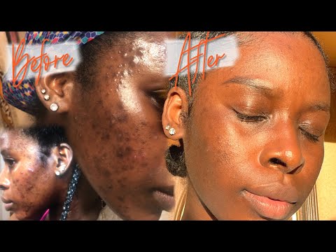 HOW I GOT RID OF MY HYPERPIGMENTATION & CYSTIC ACNE FAST AF + SKIN CARE JOURNEY *HIGHLY REQUESTED*