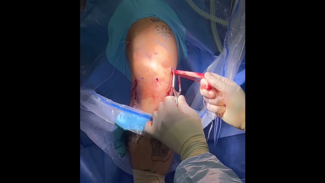 Updated MCL reconstruction with internal brace
