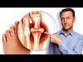 Remedy for Gout and Uric Acid - Straight From the Garden