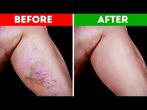 10 Natural Ways to Get Rid of Varicose Veins and Increase Blood Flow