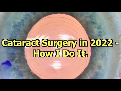 Cataract Surgery in 2022   How I Do It.