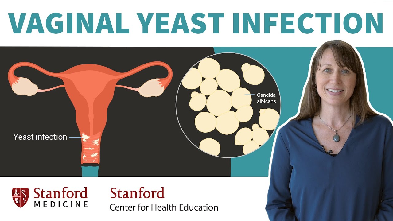 Say Goodbye to Vaginal Yeast Infections Forever: Expert Tips from Stanford, Beauty Vigour