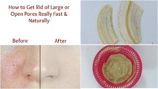 Get rid of large or open pores really fast | Get smooth fairer skin
