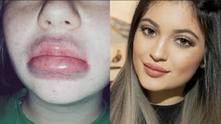 Kylie Jenner Lip Challenge Gone Wrong Free Video Search Site