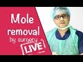 Live Mole removal surgery by Dr Jangid