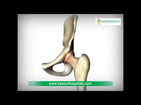 Joint Replacement Telangana | Best Orthopedic Hospital Hyderabad