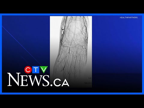 Frostbite safety and ways to treat it