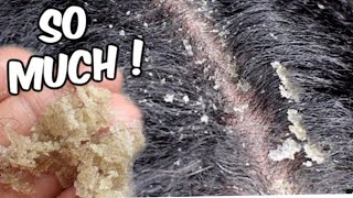 SAY GOODBYE TO DANDRUFF FOREVER WITH THIS HOME REMEDY|HOW TO GET RID OF DANDRUFF FAST AT HOME