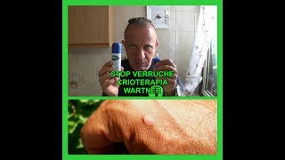 Congela la verruca alla radice e sparirà per sempre Crioterapia tutorial