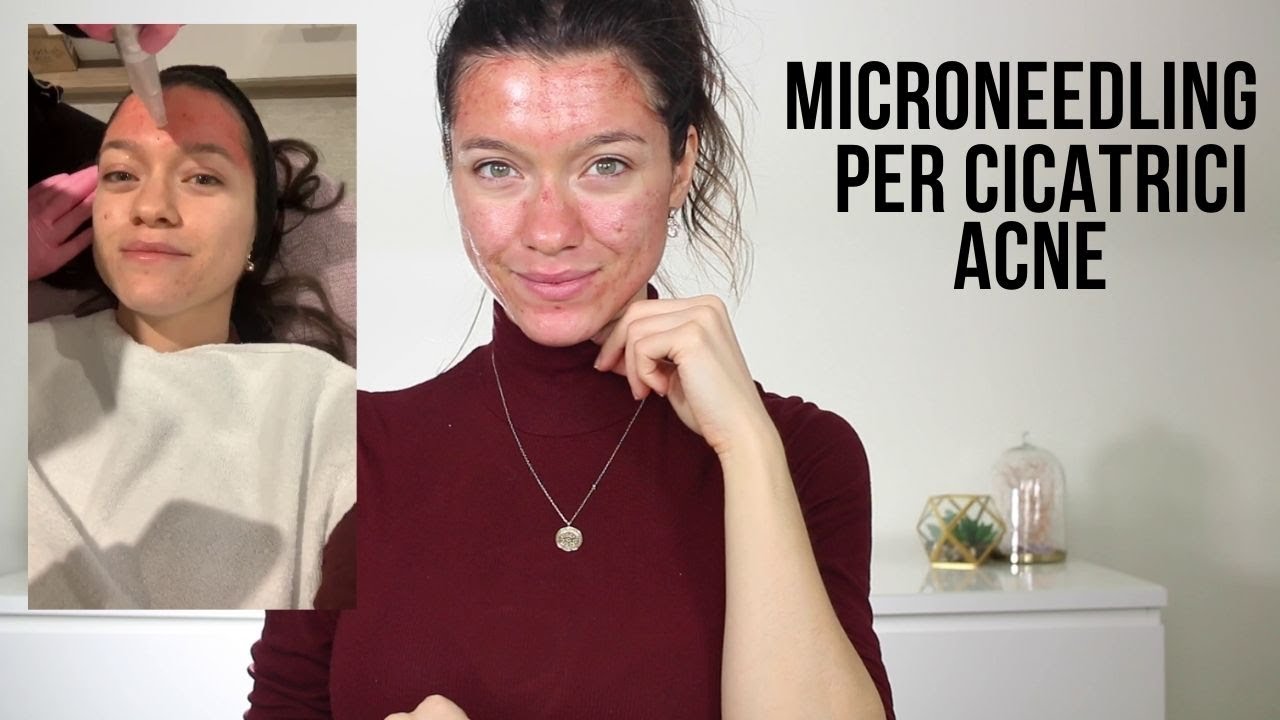 Cicatrici Acne, Microneedling Esperienza e Update La Mia Pelle è Perfetta