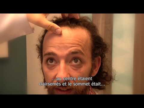 download lagu mp3 mp4 Microgreffe Cheveux Bruxelles, download mp3 Microgreffe Cheveux Bruxelles free download, download mp3 Microgreffe Cheveux Bruxelles