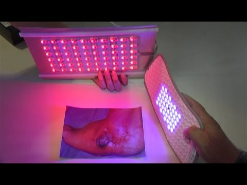 Diclofenac-Injektionen Behandlung Osteochondrose Unfixierten Skoliose der Brustwirbelsäule 1 Grad