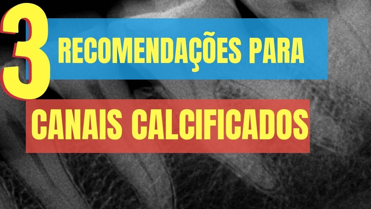 3 RECOMENDAÇÕES ANTES DE COLOCAR A MÃO EM UM CANAL CALCIFICADO! - QUICK TIP ENDOLOVERS