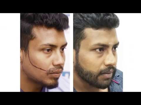 download lagu mp3 mp4 Beard Transplant Cost Uk, download lagu Beard Transplant Cost Uk gratis, unduh video klip Beard Transplant Cost Uk
